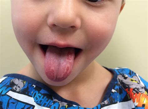 Check Out This Tongue Its Geographic Pediatric Answers