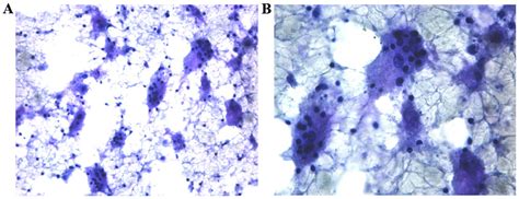 Cytological Diagnosis Of Rosai‑dorfman Disease A Case Report And