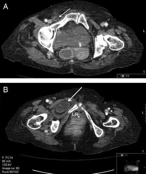 Coexisting Ipsilateral Right Femoral Hernia And Incarcerated Obturator