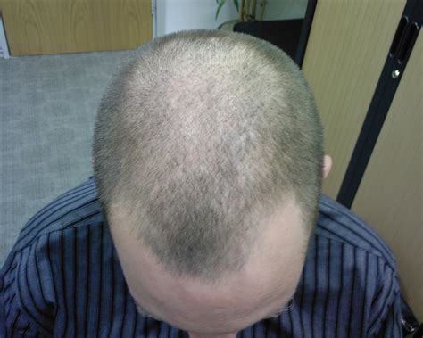 The Hair Loss Centre Alopecia Areata Jasons Story