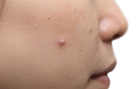 Closed Comedones White Bumps On Face Not Milia Acne Wikipedia Whiteheads Are Also Known As