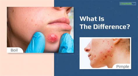 Boil Vs Pimple What Is The Difference True Health Tips