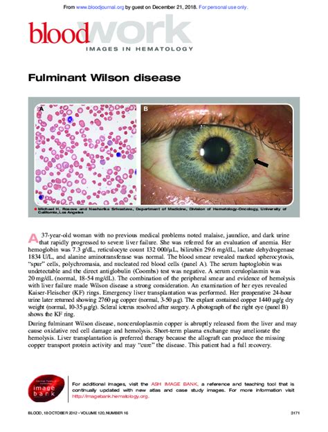 Pdf Fulminant Wilson Disease Michael Rosove