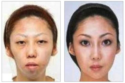 Asian Plastic Surgery Before After Xxx Porn Library
