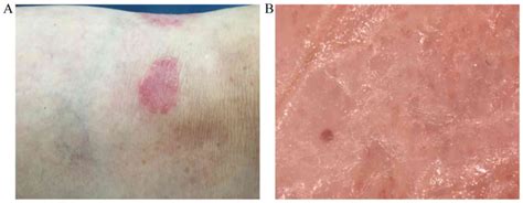 Imaging Techniques In The Diagnosis And Monitoring Of Psoriasis Review