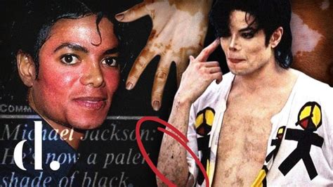 Did Michael Jackson Suffer From Vitiligo If So How Would It Affect His Performance On Stage