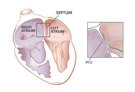 Patent Foramen Ovale Heart Care Intermountain Healthcare