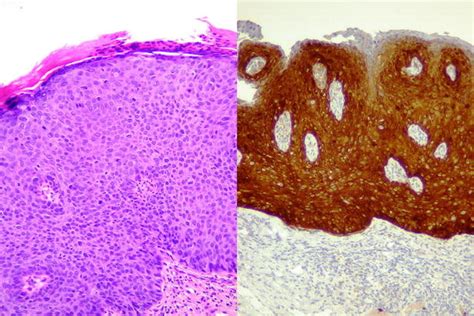 Microscopic Findings Of Vulvar Intraepithelial Neoplasia Grade 3