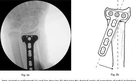 Figure 2 From Correction Of Dorsally Malunited Extra Articular Distal
