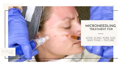 Microneedling Treatment For Acne Scars Youtube