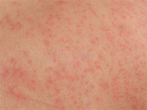 1208 Rashes Skin Stock Photos Free And Royalty Free Stock Photos From