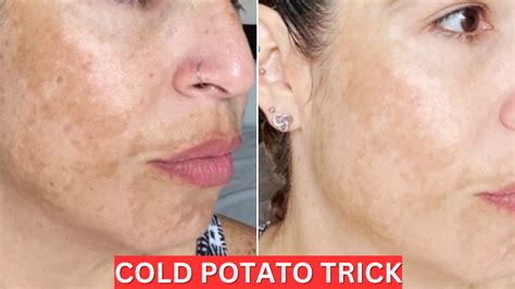 Cold Potato Trick To Remove Dark Spots From Face Glowpink