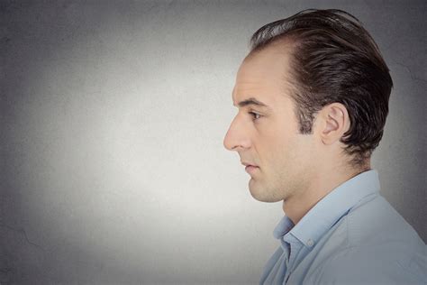 Early Signs Of Balding 2020 Hair Loss Geeks