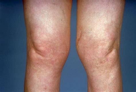 Background and diagnosis of borrelial lymphocytoma borrelial lymphocytoma is a rare the most common site of borrelial lymphocytoma is the ear lobe in children and the breast, on or near. Healthy Life: Lyme Disease