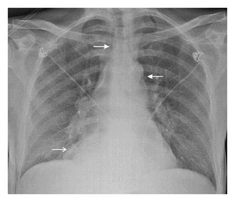 When seen alongside neutrophilic leukocytosis, these features are sufficient to make a clinical diagnosis using appendicitis scoring systems to estimate the likelihood of appendicitis. Posts | Department of Emergency Medicine | Saint John | Page 4