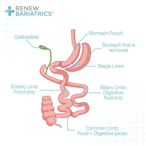 Gastric Bypass Vs Duodenal Switch Which Is Best Expected Weight Loss