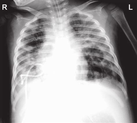Chest Radiograph On Day 39 Showing Collapse Of The Right Lower Lobe