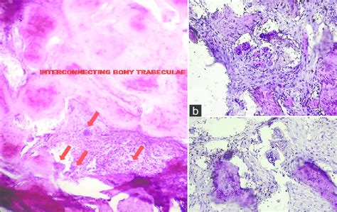 Photomicrograph Shows Interconnecting Bony Trabeculae In Central Area