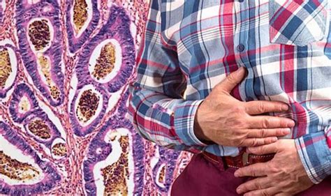 Bowel Cancer Symptoms Four Signs Of A Bowel Obstruction Go To Aande
