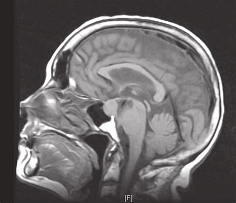 Sagittal View Of Head Mri T1 Showing The Pituitary Macroadenoma