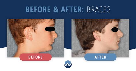 How Braces Change Face Shape (Before & After)