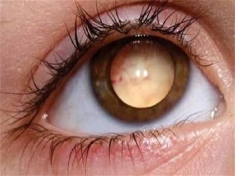 10 Of The Most Bizarre Eyes In The World