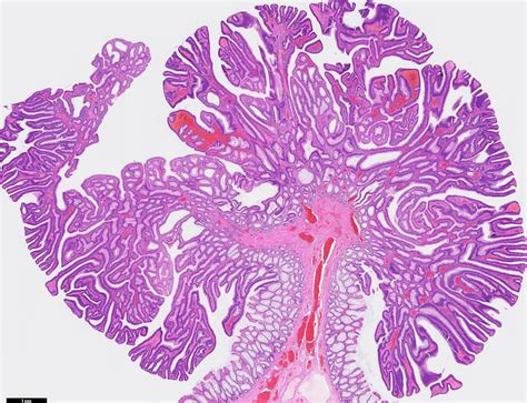 Tubular Adenoma Histology