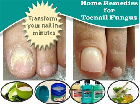Home Remedies For Toenail Fungus Apply Natural Ways