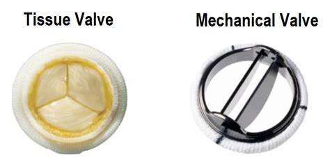 Mechanical Heart Valves Are There Natural Alternatives To Coumadin