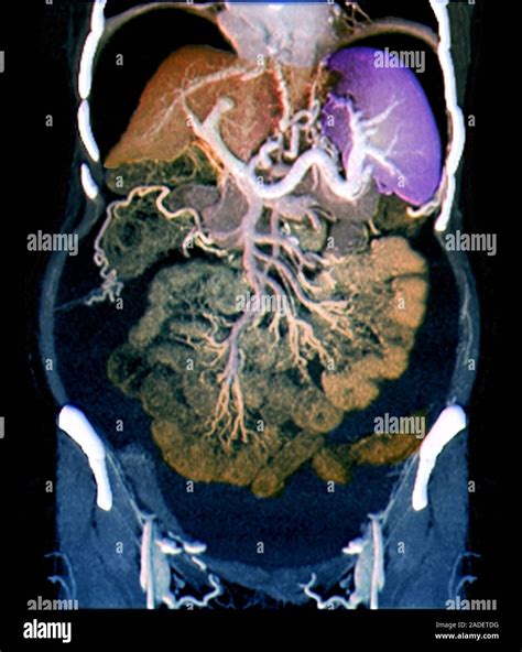 Swollen Abdomen In Cirrhosis Coloured Computed Tomography Ct Scan Of