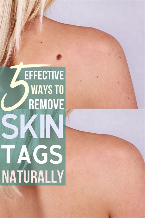 5 effective ways to remove skin tags naturally