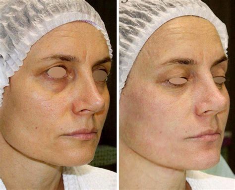 Thermage Before And After Facelift Info Prices Photos Reviews Qanda