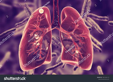 Discover More Than 62 Tuberculosis Wallpaper Latest Noithatsivn