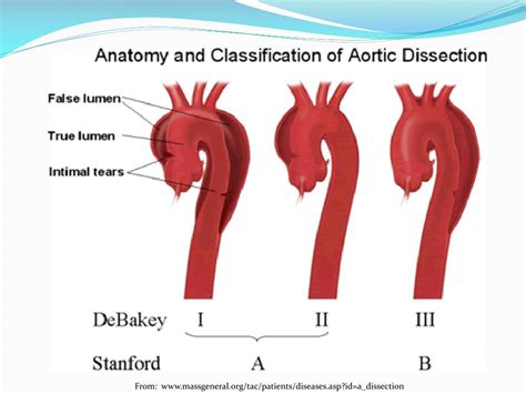 Ppt Aortic Dissection Powerpoint Presentation Free Download Id3084985
