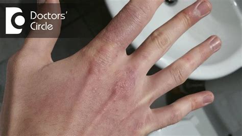 causes of black spots cuts and itching on fingers dr aruna prasad youtube
