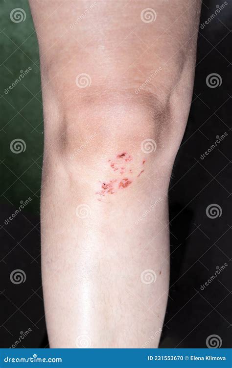Bruised Knee Blood Abrasions On The Leg Knee Scratches Injury Stock