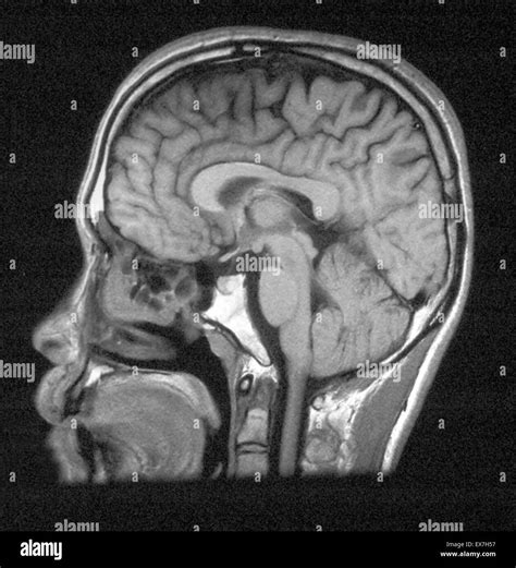 Mri Of Head Showing Normal Brain Structures Stock Photo Alamy