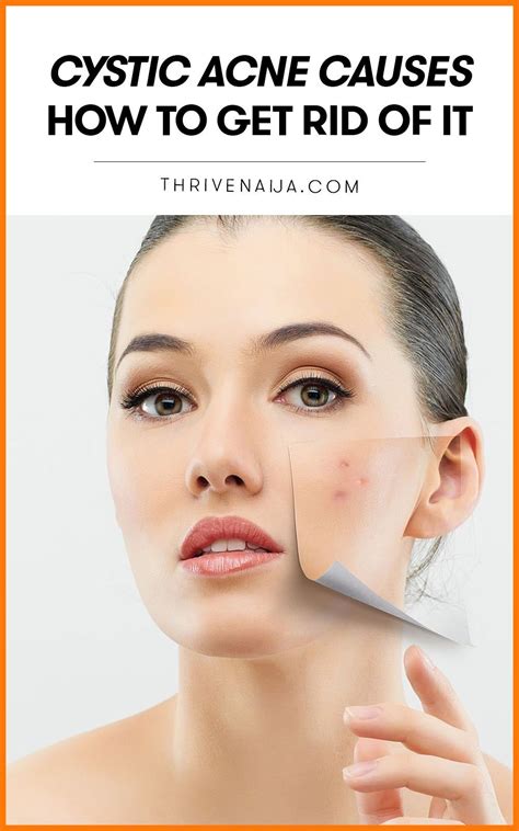 Discover What Causes Cystic Acne And How To Manage This Irritating Skin