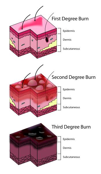 Burn pictures first second and third degree. First Degree Burn. Causes, symptoms, treatment First ...