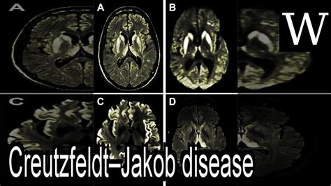 Creutzfeldtjakob Disease Wikividi Documentary Youtube