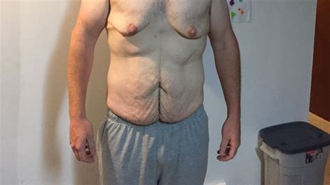 Man Who Lost 200 Pounds Fundraises For Surgery To Remove Excess Skin Ctv News