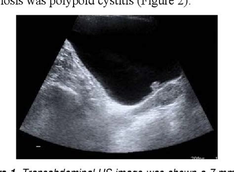Figure 1 From A Case Of Polypoid Cystitis Mimicking Bladder Tumor In