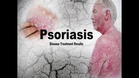 Psoriasis Disease Treatment Youtube
