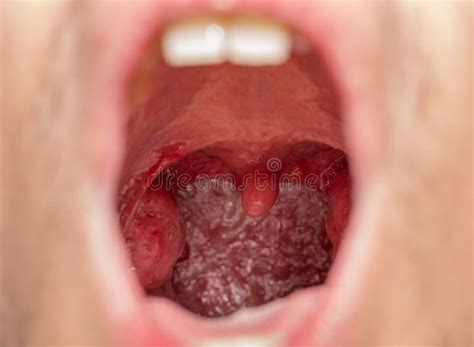 Open Mouth View Of Tonsils Stock Photo Image 43119807