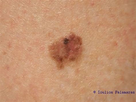 Skin Cancer And Pigmented Skin Lesions Ioulios Palamaras Md Phd