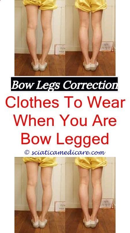 Permanent Remedy For Bow Legs Bull Legged Or Bow Leggedbow Leg