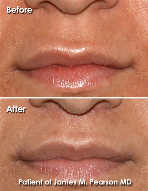 Lip Lift Dr James Pearson Facial Plastic Surgery