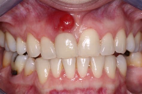 Acute Alveolar Abscess