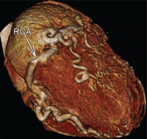 Termination of left anterior descending. Anomalous Origin of the Left Coronary Artery from the Pulmonary Artery: Diagnosis with CT ...