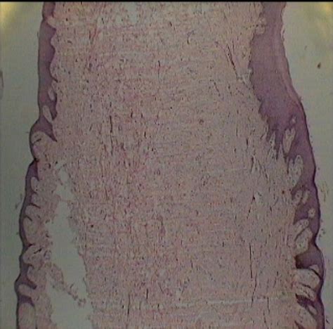 Figure From Giant Cell Fibroma A Case Report Semantic Scholar